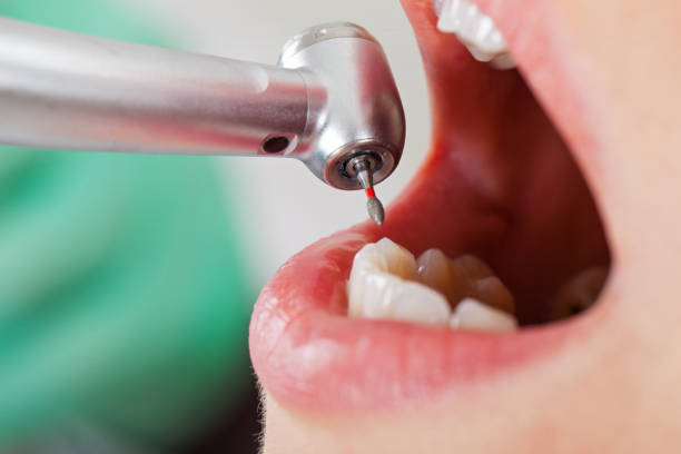 Best Chipped Tooth Repair Near Me  in Salem, OH